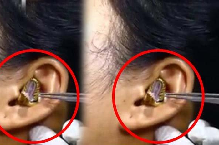 Dokter berupaya mengeluarkan seekor ular dari telinga seorang wanita.