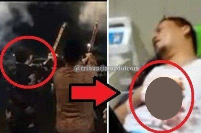 Tangan Wakil Bupati Kaur terluka parah usai kembang api meledak di tangannya saat malam perayaan Tahun Baru 2023. 