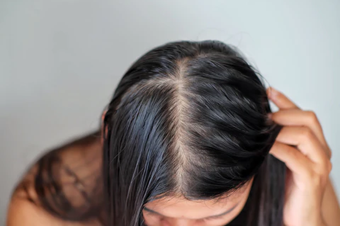 Ilustrasi rambut tipis