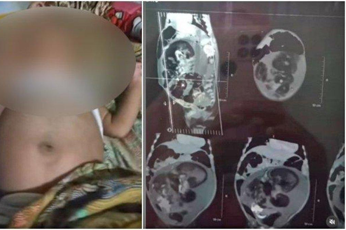 Bayi laki-laki di Sumatera Barat yang perutnya buncit dan diduga hamil. Dokter sebut itu tumor 