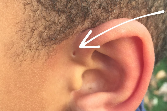 Preauricular sinus