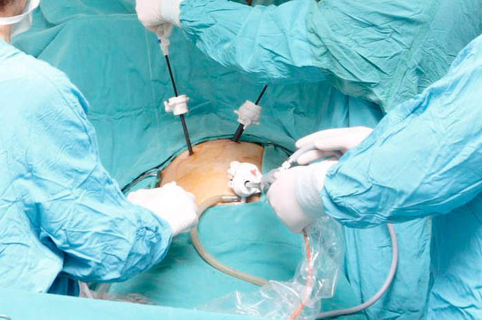 Transplantasi Ginjal dengan Teknik Laparoskopi