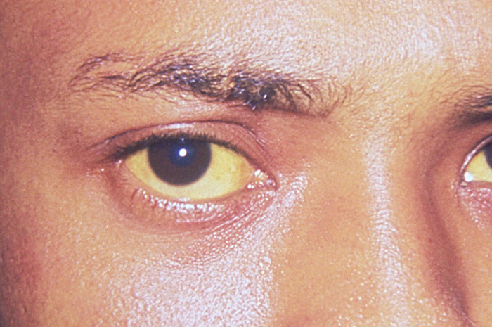 Hepatitis A Alias Sakit Kuning