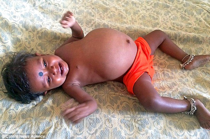 Mengidap Fetus in Fetu, Balita Ini 'Mengandung' Saudara Kembarnya Sendiri