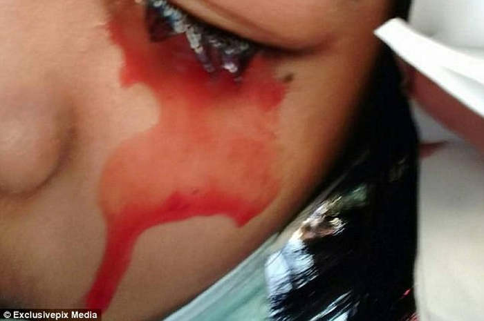 Setiap menderita sakit kepala, gadis ini mengeluara darah.