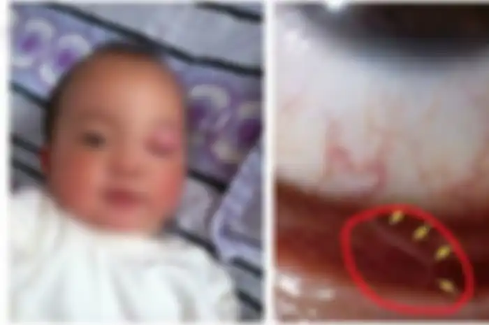 Karena Abaikan Hal Sepele, Mata Anak 2 Tahun Ini Dipenuhi Belasan Cacing