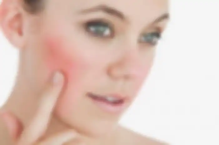 Ilustrasi rosacea