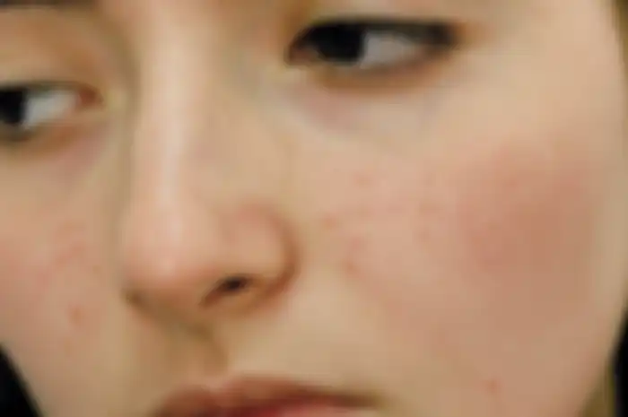 noda hitam