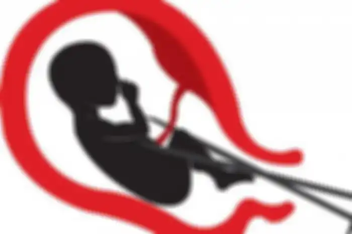 Ilustrasi aborsi.