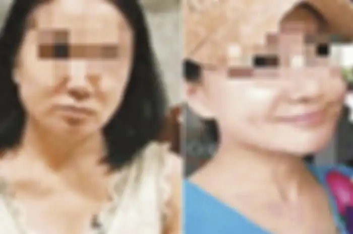 Wajahnya sebelum melakukan operasi plastik