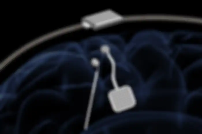 Alat pacu otak ini mampu monitor, rekam, dan berikan kejutan listrik yang dibutuhkan otak pada penderita Parkinson dan epilepsi.