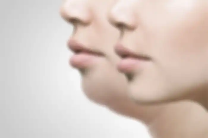 Ilustrasi double chin
