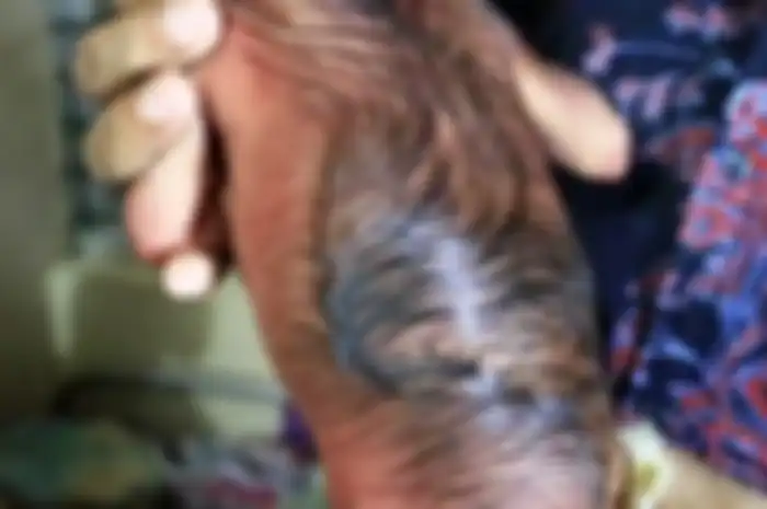 Bagian punggung bayi yang ditumbuhi rambut lebat