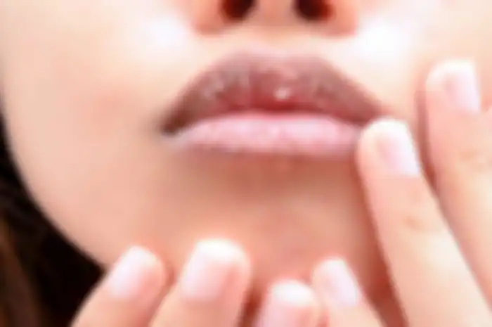 Bibir pecah-pecah dan kering.