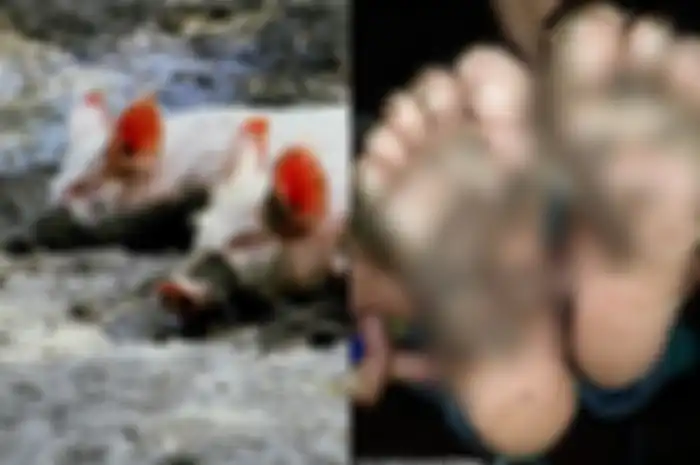 Telapak kaki seorang anak terinfeksi usai bermain di kandang babi tanpa alas kaki.