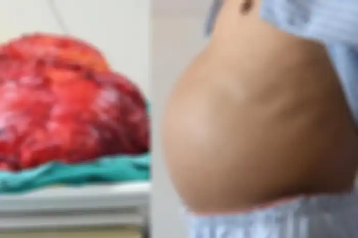 Tumor Seberat Hampir 30 Kg Berhasil Diangkat dari Perut Pria yang Terus Membesar ini