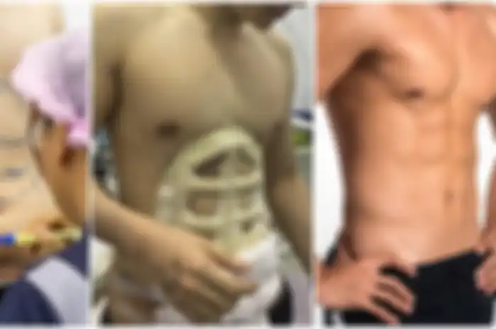 Metode operasi terbaru untuk mendapatkan tubuh six pack