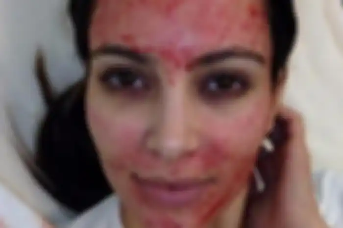 Kim Kardashian lakukan perawatan Vampire Facial (Foto:Medical Daily)