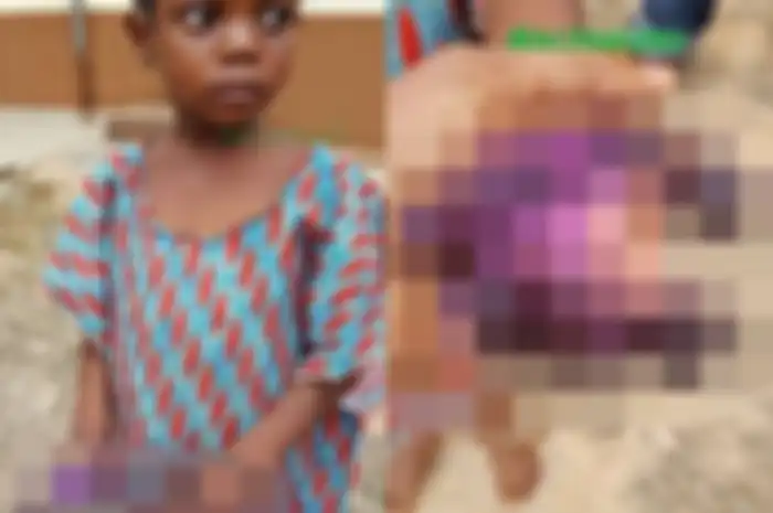 Hanya Karena Sebungkus Mie Instan, Jari-Jemari Gadis Cilik ini Hancur