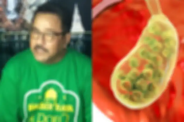 Kolase Rano Karno dan Batu Empedu