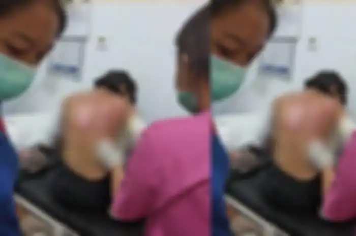 Kulit korban melepuh disiram air panas (Foto: Ist)