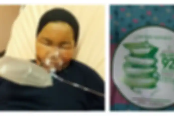 Pakai Skincare Palsu, Wanita ini Berakhir di Rumah Sakit Karena Wajahnya Melepuh!