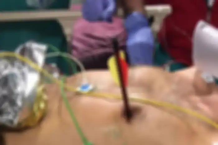 Tertancap Panah Hingga Tembus ke Paru-Paru, Pria ini Tetap Terjaga Saat Dioperasi