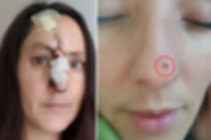 Temukan Jerawat Kecil Karena Hobi Berjemur, Wanita ini Justru Terkena Kanker Kulit