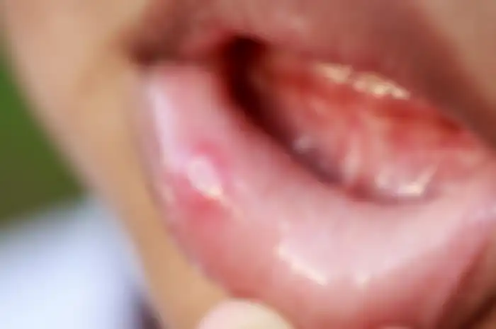 Waspadai Bercak Putih atau Kemerahan di Bibir, Bisa Jadi Tanda Kanker Mulut!