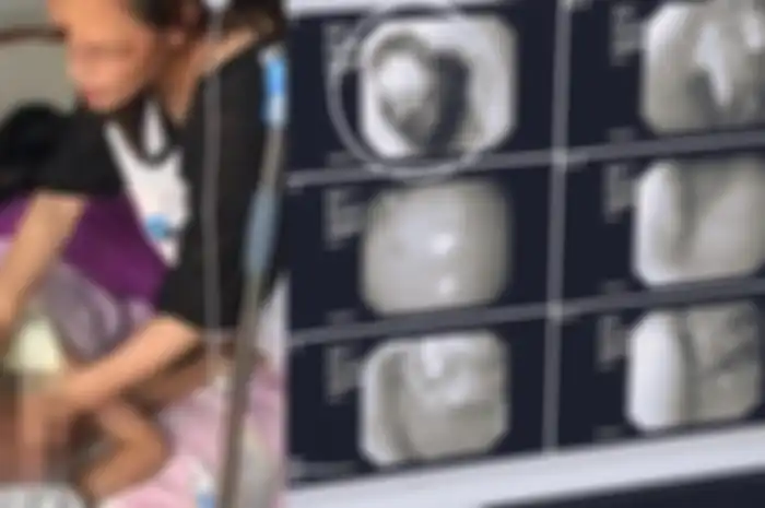 Gadis 9 Tahun Ini Mengeluh Mual, Keluarga Kaget Saat Lihat Gumpalan Berdiameter 18 Sentimeter di Perutnya!