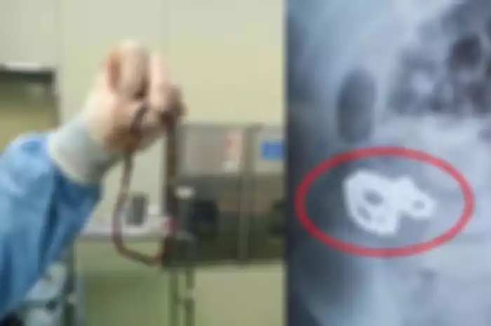 Alami Sakit Perut Luar Biasa, Dokter Justru Temukan 64 Manik-Manik Magnet di Dalam Perut Bocah ini