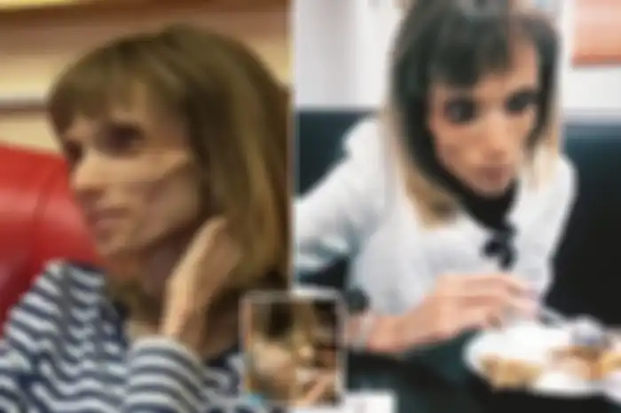 Tinggal Kulit dan Tulang, Wanita Penderita Anoreksia ini Hanya Makan Sepotong Apel dan Air