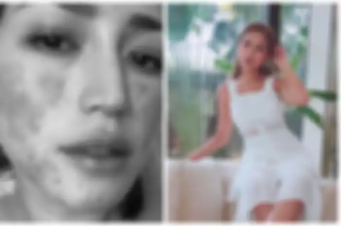 Salah Penanganan Medis, Wajah Jessica Iskandar Memerah Sampai Tak Bisa Ditutupi Makeup
