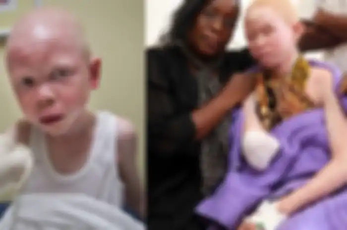 Miris! Anak-Anak Albino di Afrika Diburu dan Dimutilasi Hidup-Hidup, Bagian Tubuhnya Digunakan Untuk Praktik Ilmu Hitam