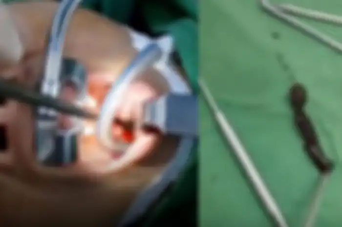 Awalnya Dikira Terkena Tumor Tenggorokan, Saat Dioperasi Dokter Justru Keluarkan Lintah dari Tubuh Wanita itu