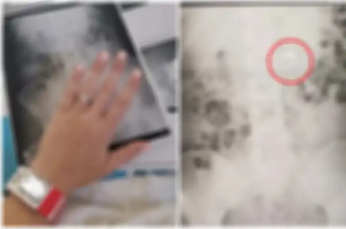 Seorang Wanita Mimpi Diminta Menelan Cincin Pertunangan, Saat Bangun Benda Itu Sudah Ada di Perutnya