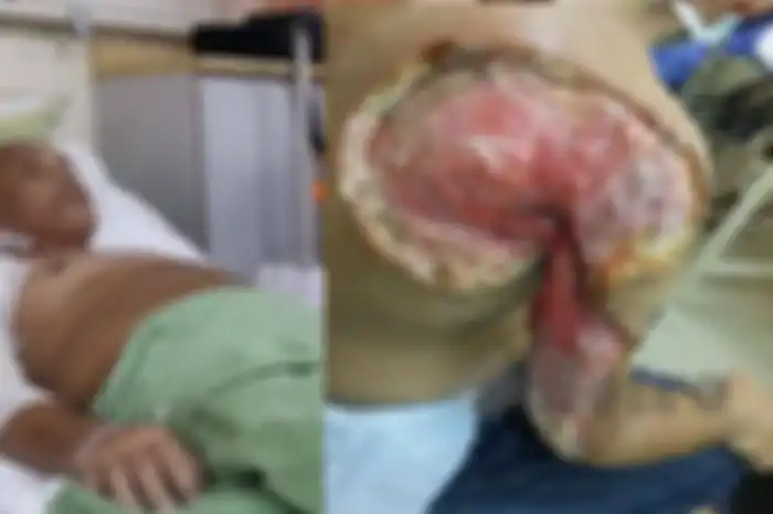 Berawal dari Bisul, Kulit Lengan Bahu dan Punggungnya Harus Diangkat Ternyata ini Penyebabnya