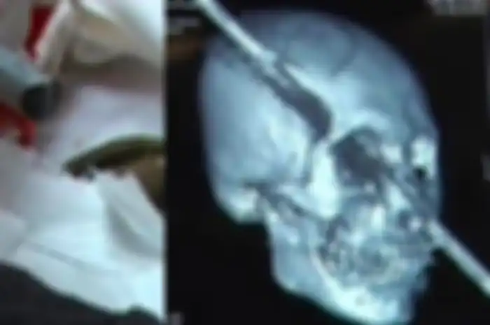 Ngeri! Batang Baja Menusuk dari Hidung Hingga Tembus ke Tengkorak Kepalanya, Pria ini Berhasil Lewati Masa Kritisnya