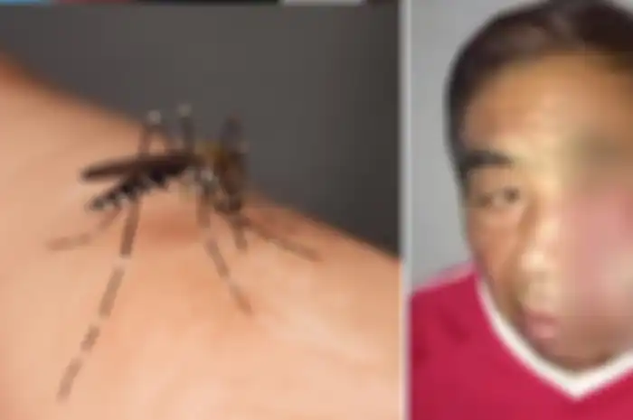 Seorang Pria Nyaris Kehilangan Nyawa Setelah Menggaruk Gigitan Nyamuk di Wajahnya
