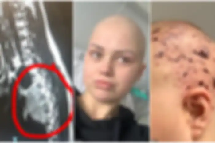 Seorang ibu muda didiagnosis mengidap kanker langka yang biasanya menyerang anak usia di bawah lima tahun
