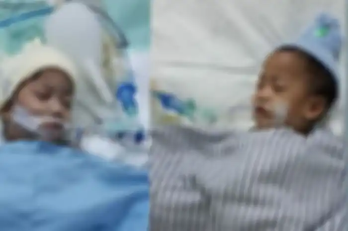 Bayi kembar siam Akila dan Azila yang berhasil dipisah