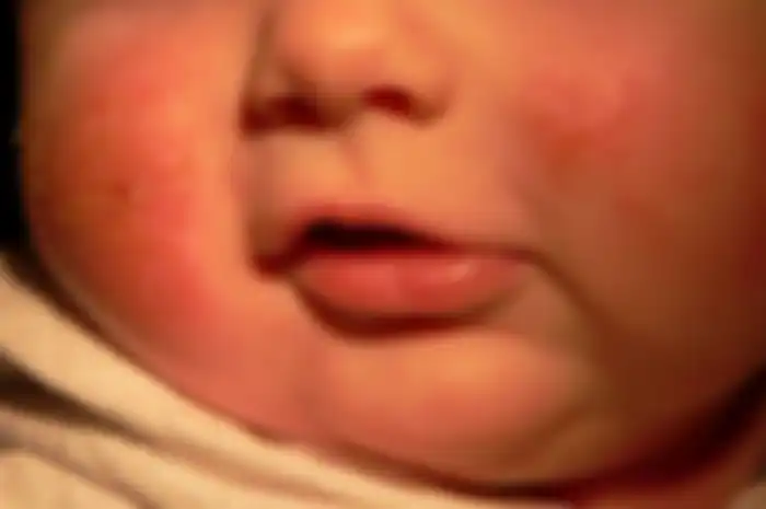 Kenali Dermatitis Atopik pada Bayi dan Anak Serta Cara Penagobatan yang Mudah