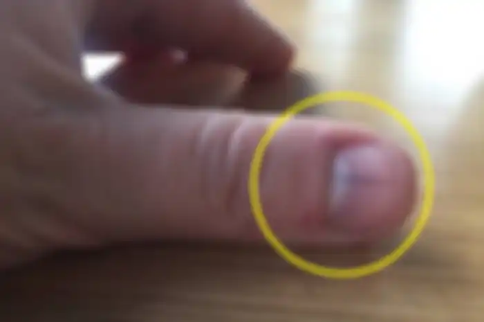 Garis hitam di bawah kuku.
