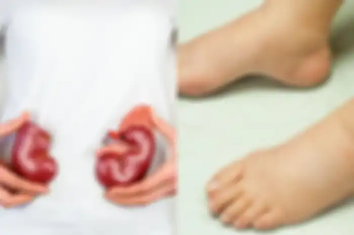 Gejala gagal ginjal salah satunya adalah kaki bengkak simetris kiri dan kanan. 