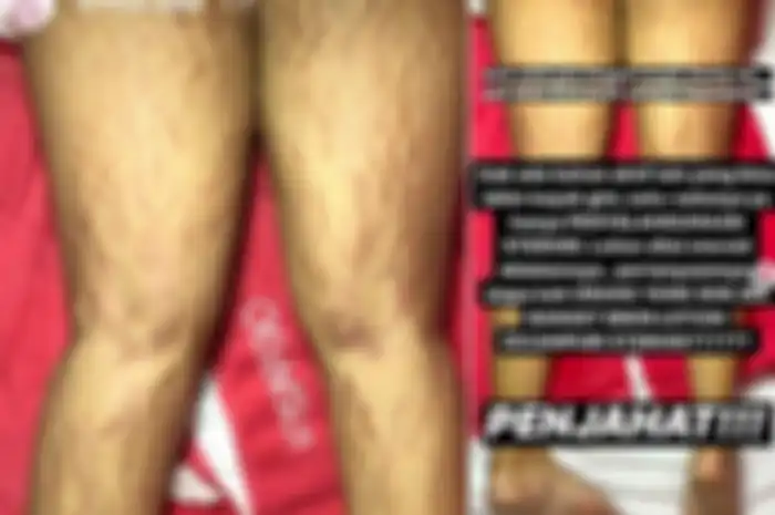 Bahaya losion mengandung steroid.