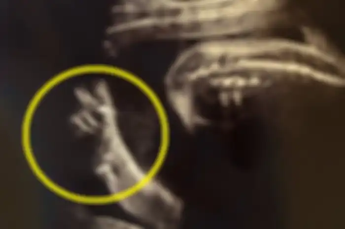 Hasil USG ibu di Jepang yang viral karena sang jabang bayi menunjukkan tanda peace dalam kandungan.