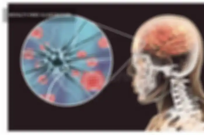 Ilustrasi Meningitis
