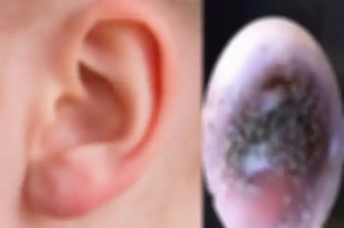 Saluran Telinga Berjamur Karena Keseringan Memakai Earphone