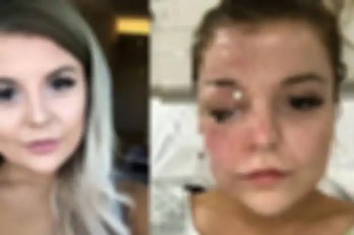 Wajah Bethany Rosser sebelum dan sesudah terkena ledakan telur yang dimasak menggunakan microwave.