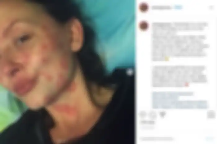 Foto cewek yang mengalami penyakit kulit yang nggak bisa disembuhkan gara-gara tragedi ciuman di malam tahun baru
